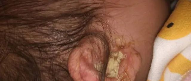 处理三岁小宝宝耳朵流脓案例-原始点全球同学网