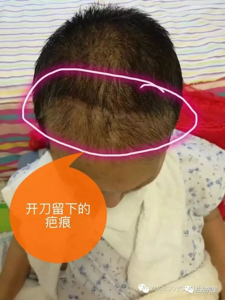 案例分享：脑癌患者一个月康复回家调理案例