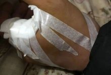 微问答122期:虎口被剪刀扎伤后,医生预判肌肉与经络严重受损可能需要手术……-原始点全球同学网