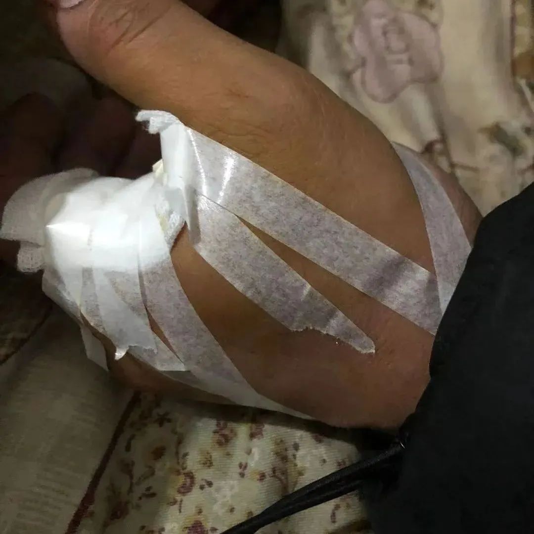 微问答122期：虎口被剪刀扎伤后，医生预判肌肉与经络严重受损可能需要手术……-原始点全球同学网