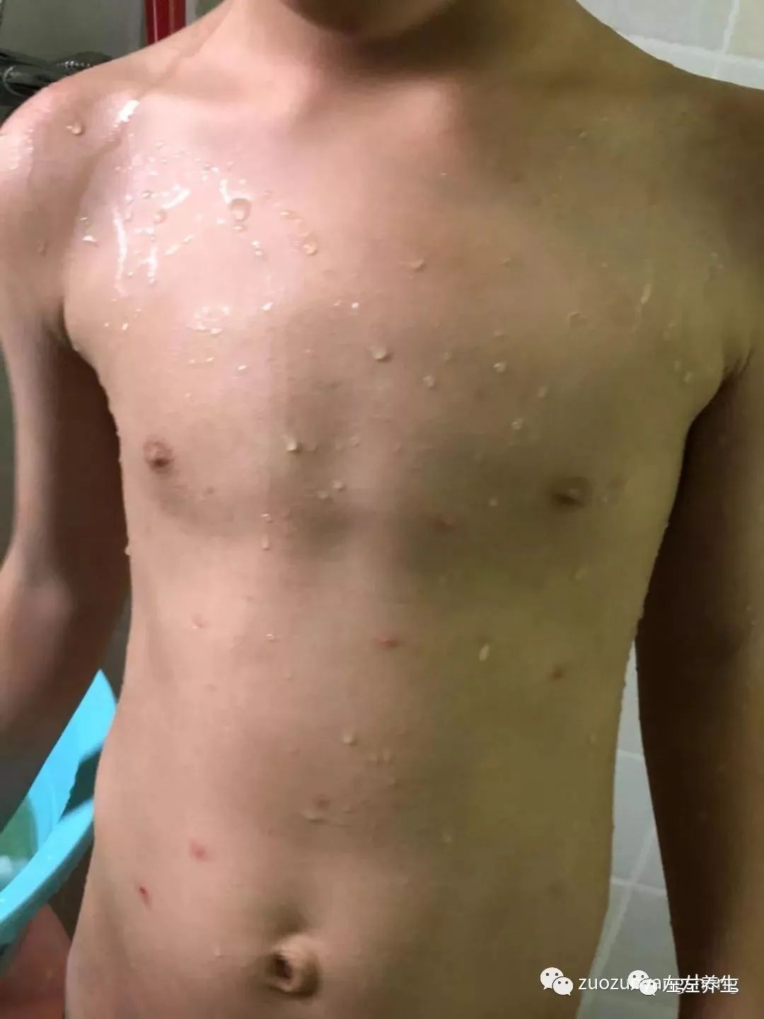 案例分享:5岁小孩水痘调理案例 案例分享:5岁小孩水痘调理案例