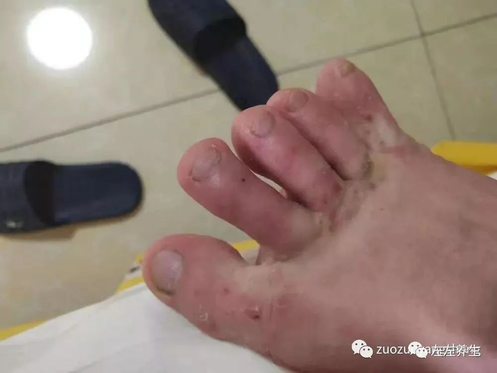 案例分享:刘老师十几年手足换季长水痘调理案例 案例分享:刘老师十几年手足换季长水痘调理案例