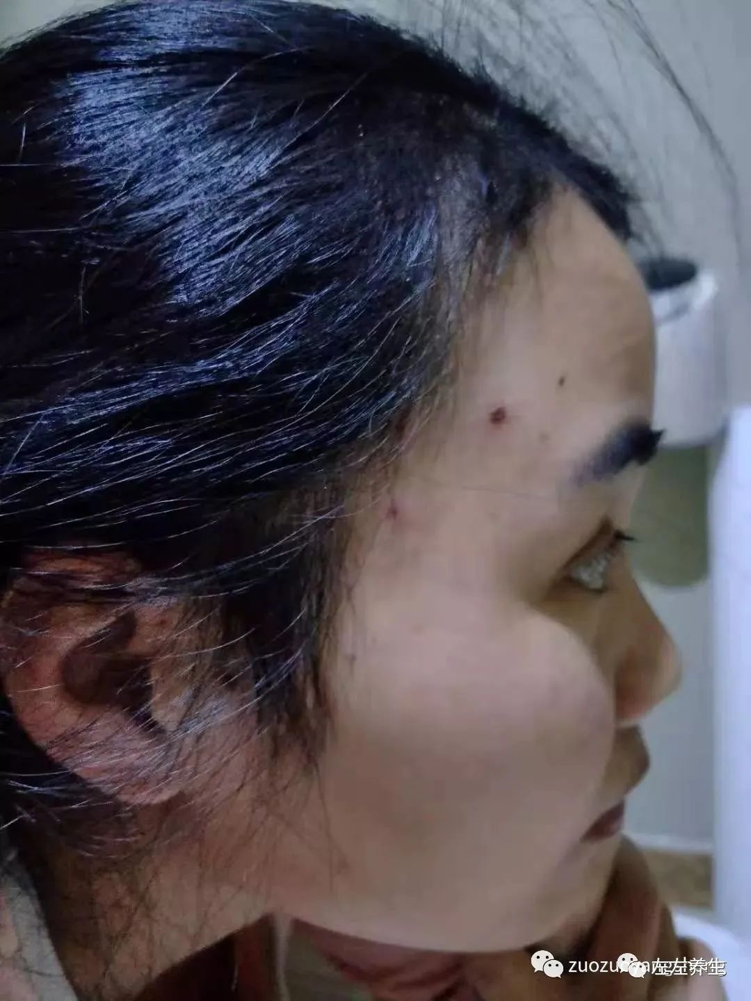 案例分享：成人水痘调理案例