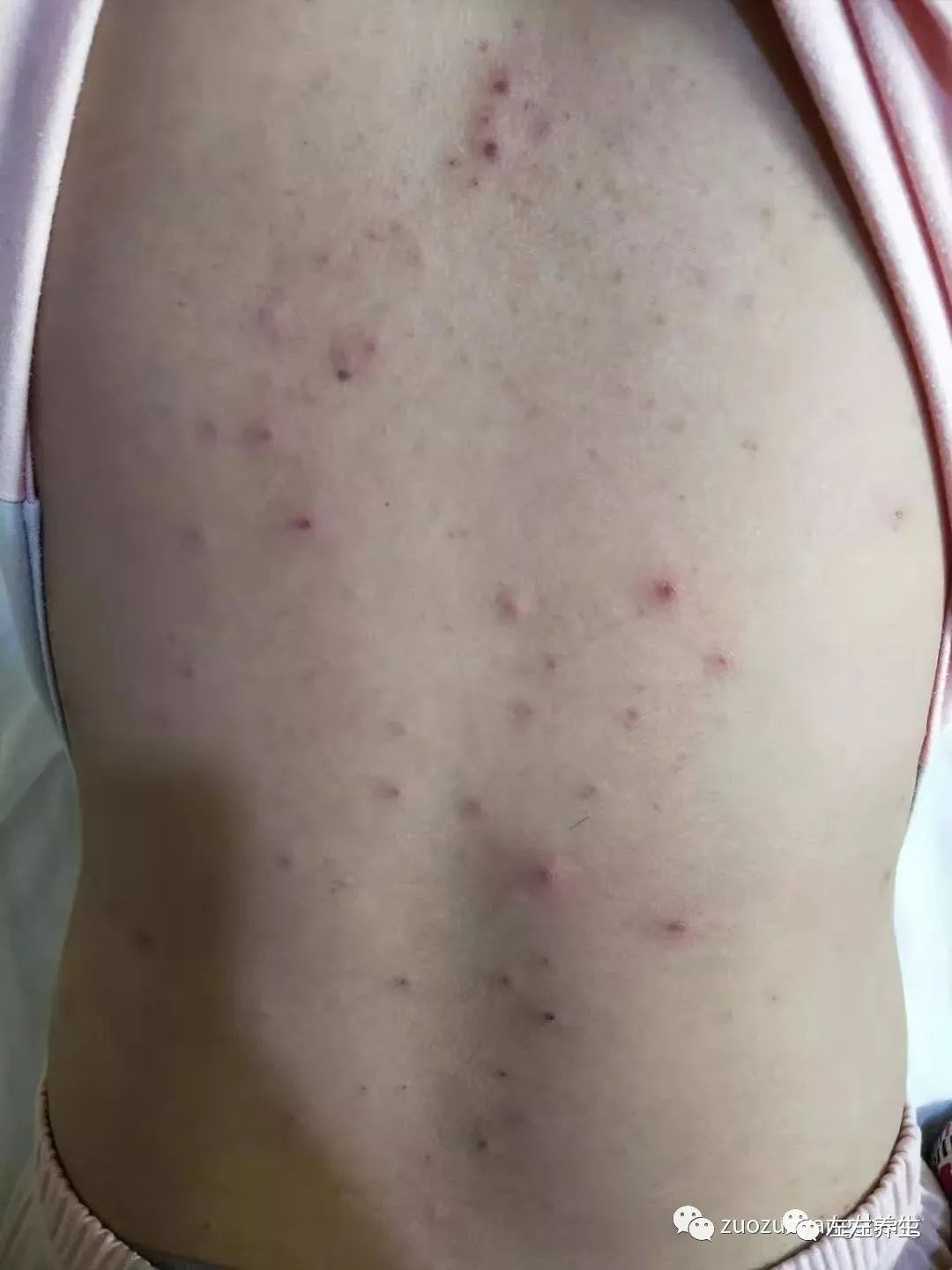 案例分享:成人水痘调理案例 案例分享:成人水痘调理案例