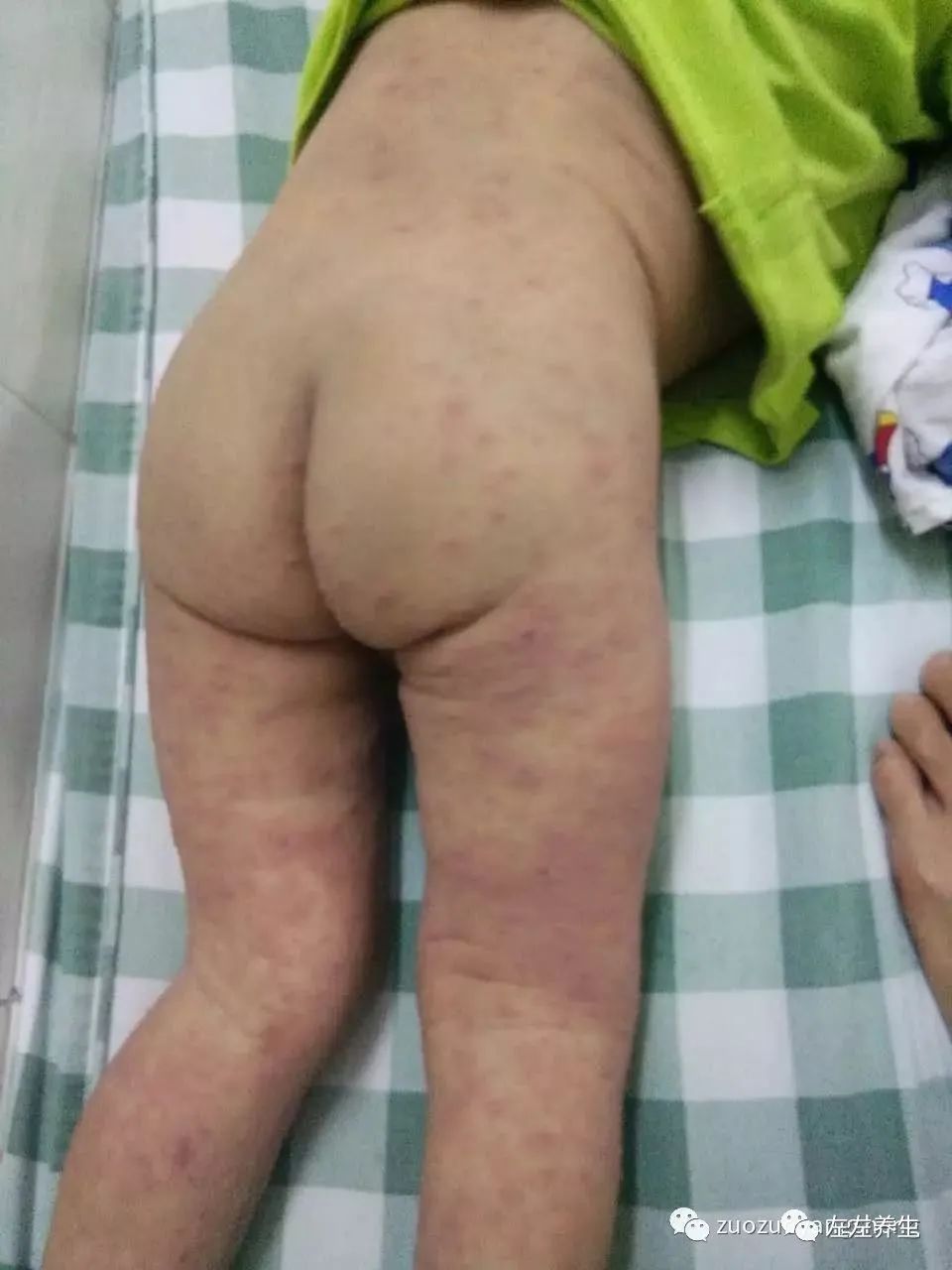 案例分享:小孩咳嗽后出现严重好转反应 案例分享:小孩咳嗽后出现严重好转反应