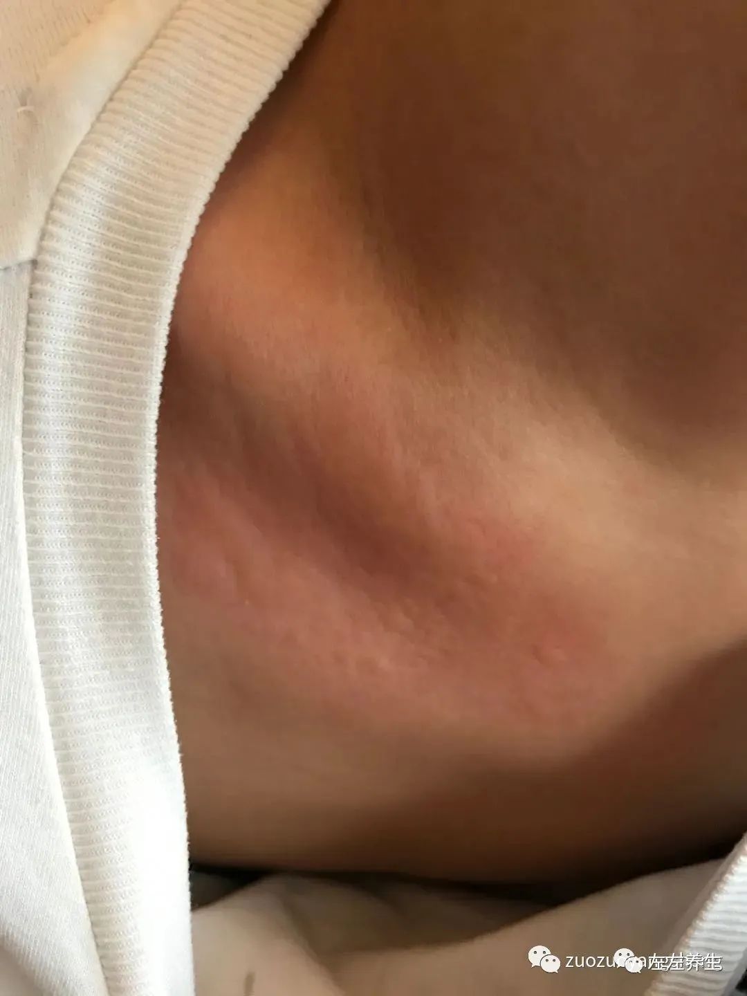 小孩疑似荨麻疹调理案例 小孩疑似荨麻疹调理案例