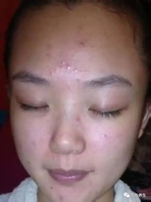 案例分享:严重青春痘和溢脂性皮炎调理案例 案例分享:严重青春痘和溢脂性皮炎调理案例