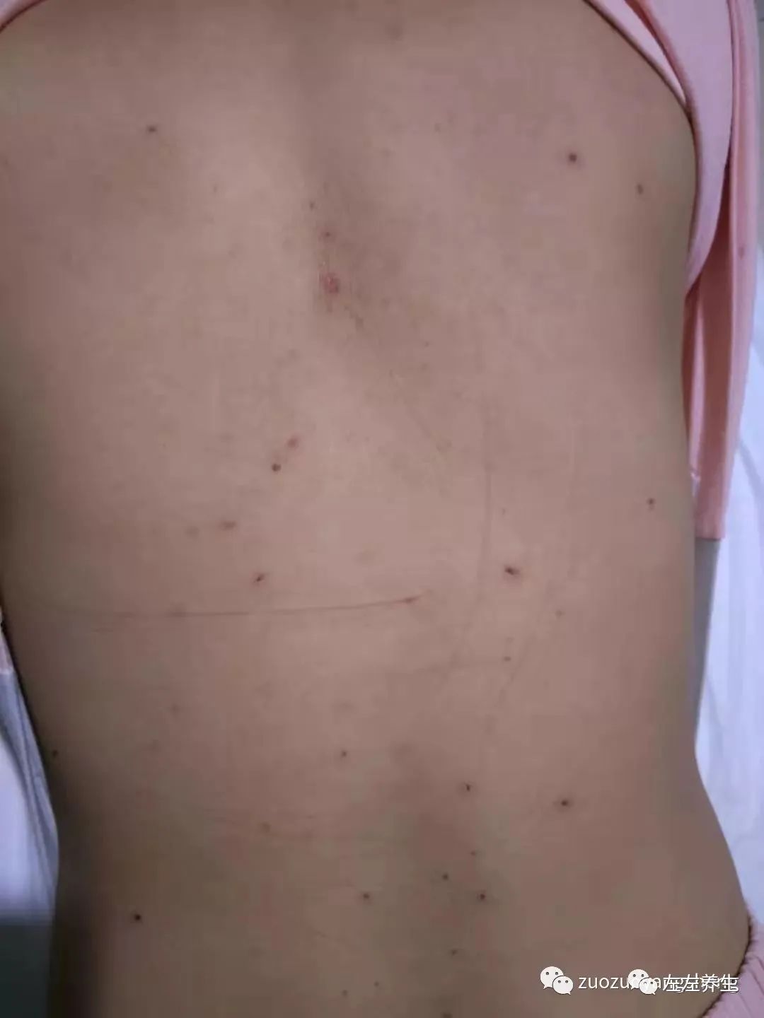 案例分享：成人水痘调理案例