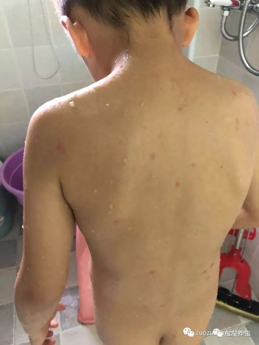 案例分享:5岁小孩水痘调理案例 案例分享:5岁小孩水痘调理案例