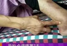 微问答80:痛风好几年了严重的时候痛的走不了路-原始点全球同学网