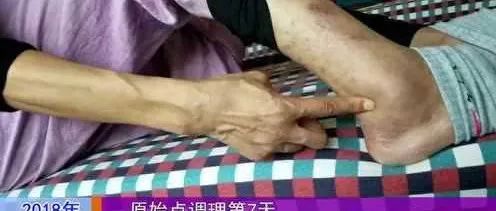 微问答80：痛风好几年了严重的时候痛的走不了路-原始点全球同学网