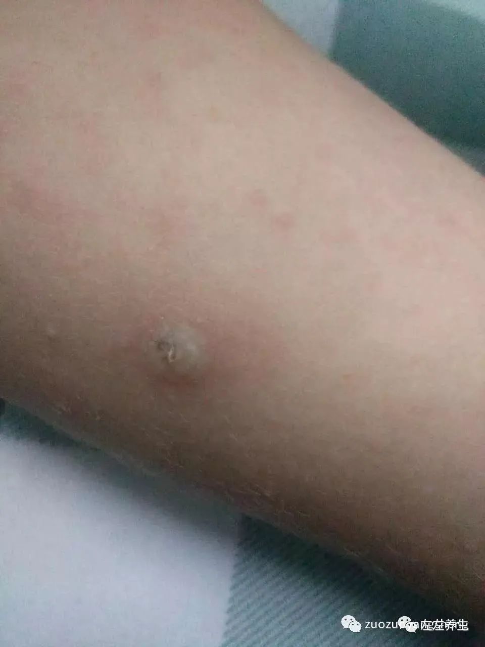 案例分享:小孩咳嗽后出现严重好转反应 案例分享:小孩咳嗽后出现严重好转反应