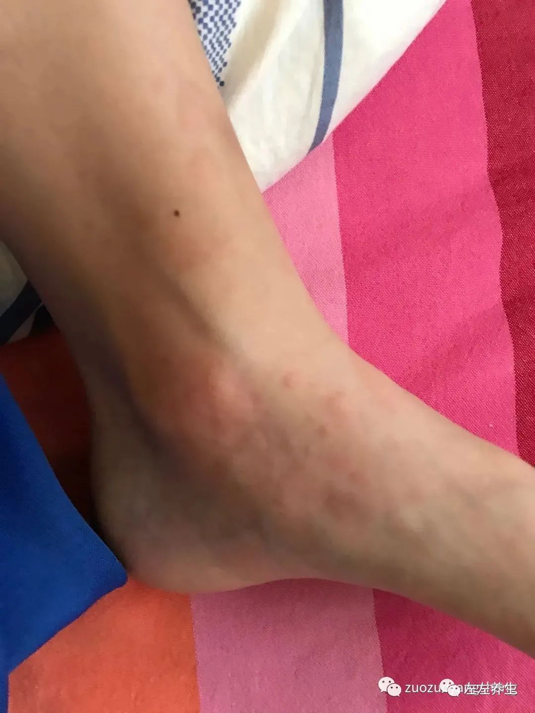 小孩疑似荨麻疹调理案例 小孩疑似荨麻疹调理案例