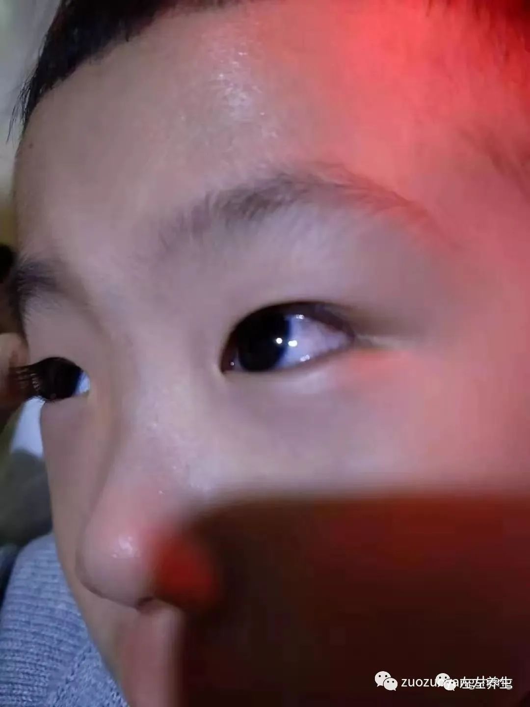 4岁小孩角膜炎调理案例 4岁小孩角膜炎调理案例