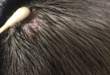 微问答92期:孩子头上红肿包块一周后溃烂,很多脓,很痛怎么办?-原始点全球同学网