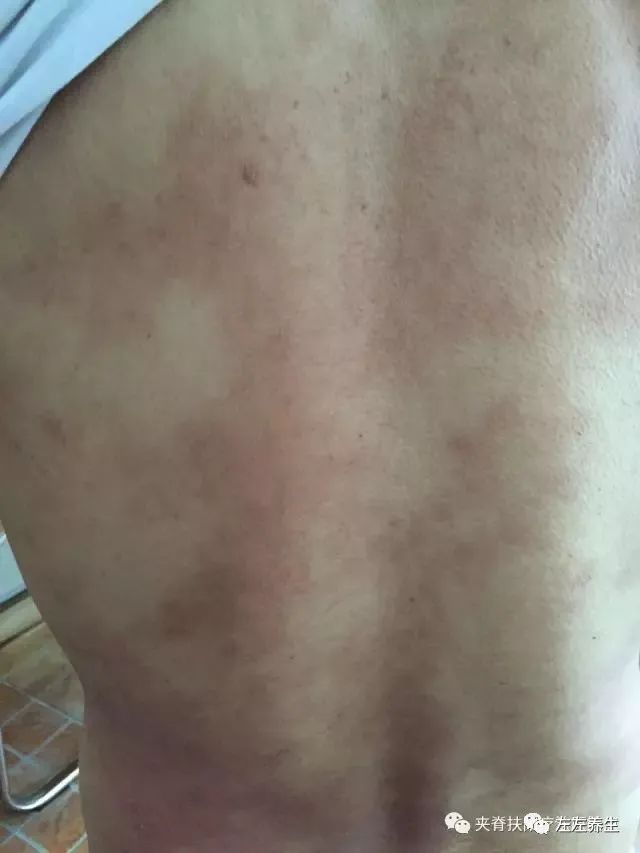 案例分享:5年荨麻疹调理案例 案例分享:5年荨麻疹调理案例