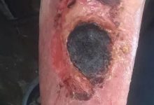 高龄老人摔伤恢复案例！-原始点全球同学网