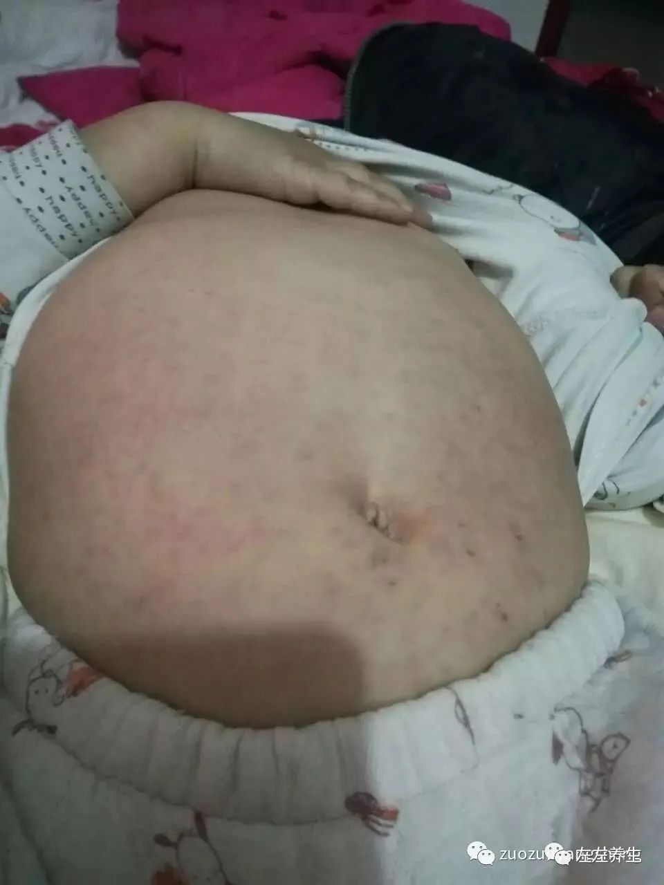 案例分享:小孩“婴幼儿急疹”调理案例 案例分享:小孩“婴幼儿急疹”调理案例