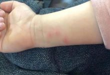 微问答129期:小孩长了一身红疙瘩,如何调理?-原始点全球同学网