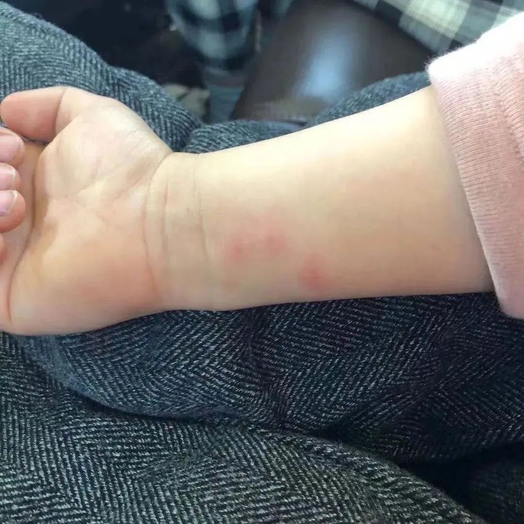 微问答129期：小孩长了一身红疙瘩，如何调理？-原始点全球同学网