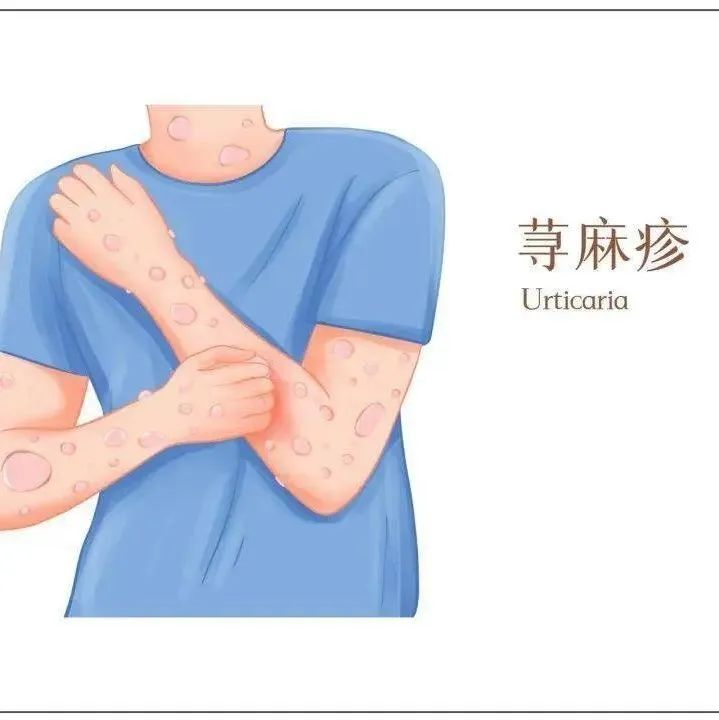 微问答136期：荨麻疹反复发作可以调理吗？-原始点全球同学网