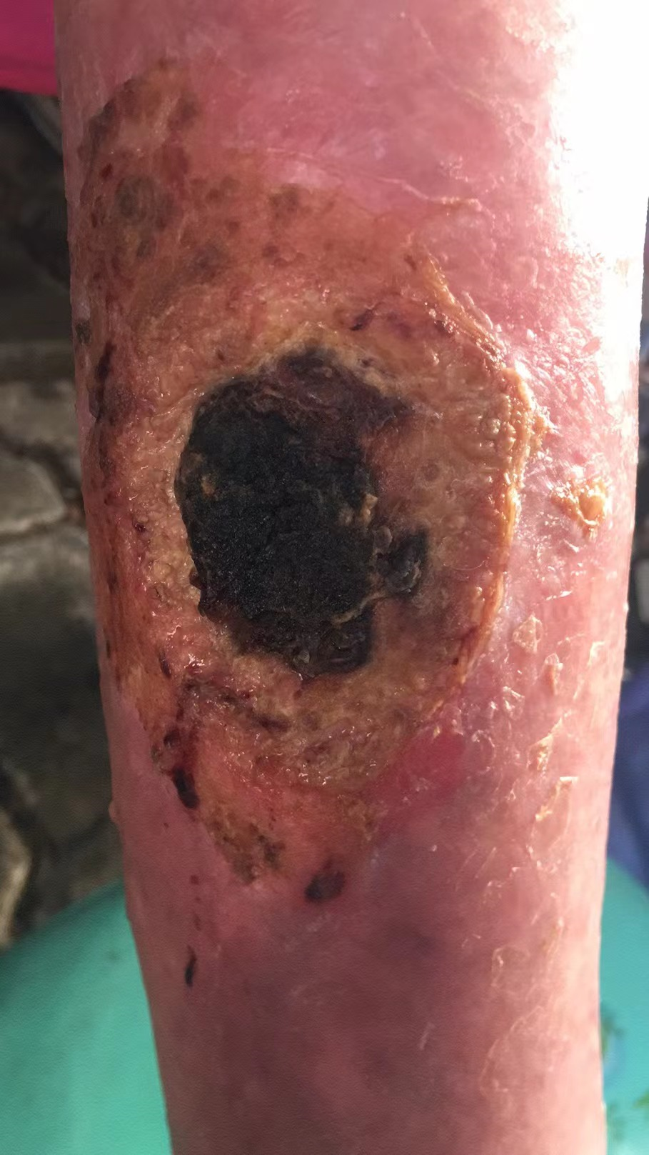 高龄老人摔伤恢复案例！