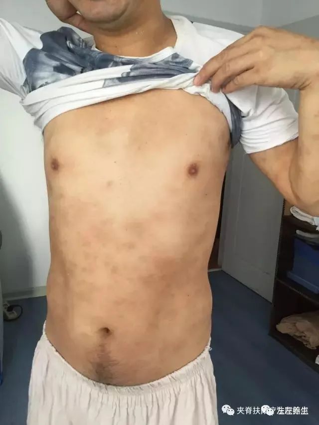 案例分享:5年荨麻疹调理案例 案例分享:5年荨麻疹调理案例