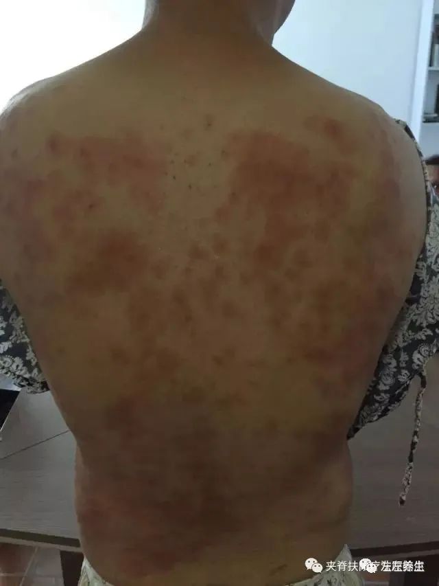 案例分享:5年荨麻疹调理案例 案例分享:5年荨麻疹调理案例