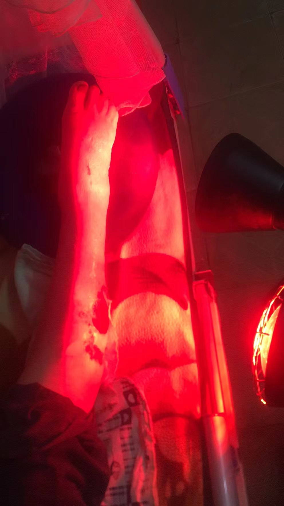 高龄老人摔伤恢复案例！