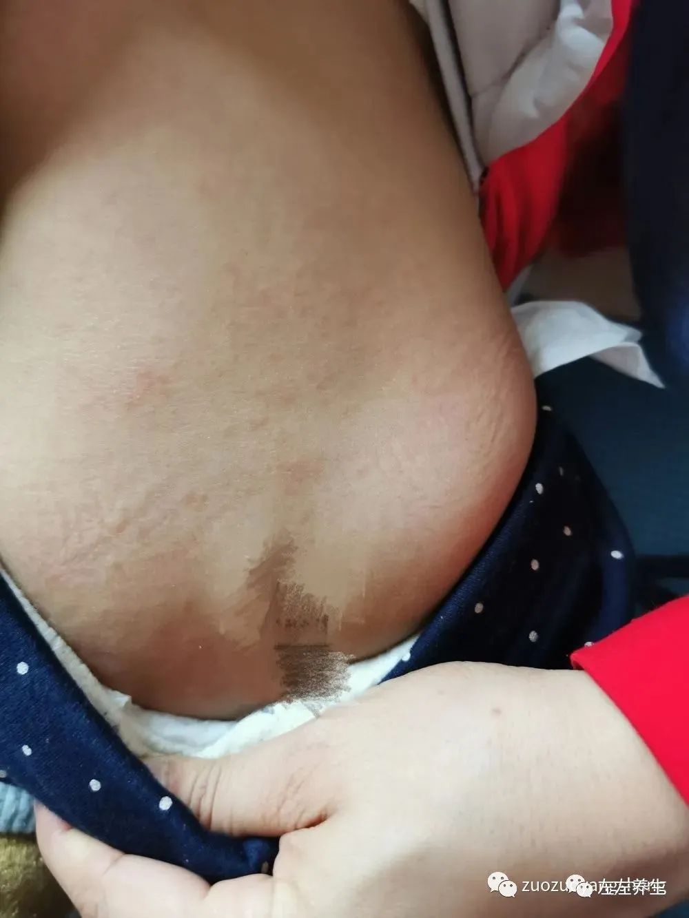 案例分享：婴幼儿急诊与反复高烧调理案例