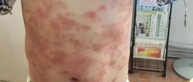 案例分享：5年荨麻疹调理案例-原始点全球同学网