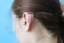 案例分享:8岁小孩左耳突然疼痛难忍调理案例-原始点全球同学网