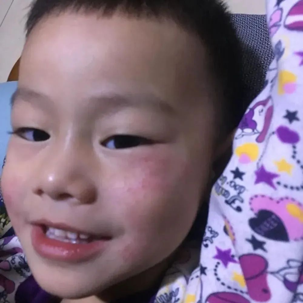 案例分享：小孩湿疹调理案例-原始点全球同学网