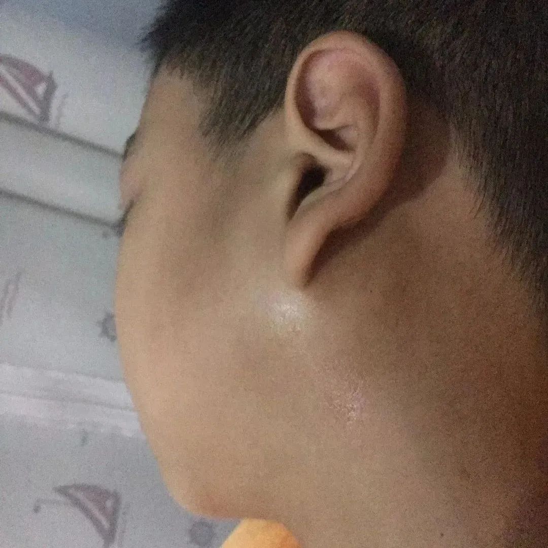 案例分享：儿子腮腺炎调理案例-原始点全球同学网