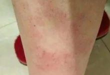 如何方便快速的解决全身痒问题?-原始点全球同学网