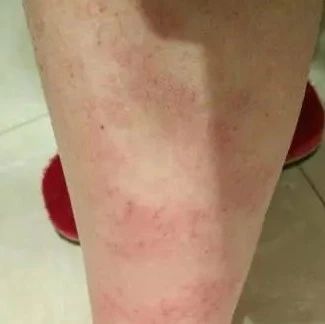 如何方便快速的解决全身痒问题？-原始点全球同学网