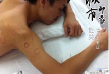 案例分享:神经损伤、肌肉萎缩经过五个月原始点理疗恢复到原样!-原始点全球同学网