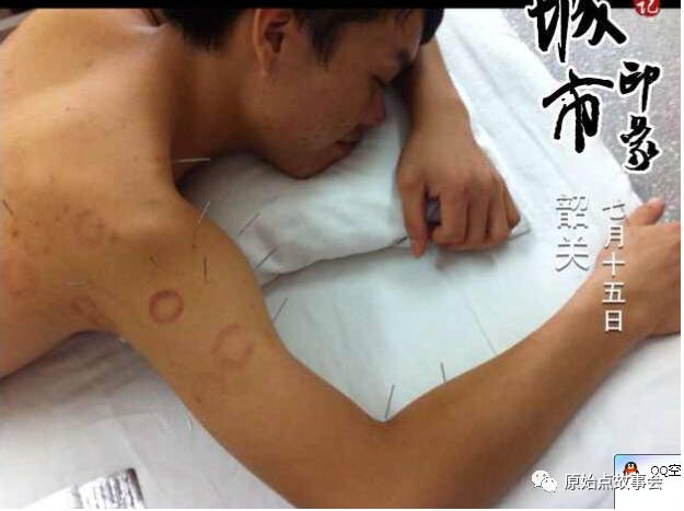案例分享：神经损伤、肌肉萎缩经过五个月原始点理疗恢复到原样！-原始点全球同学网