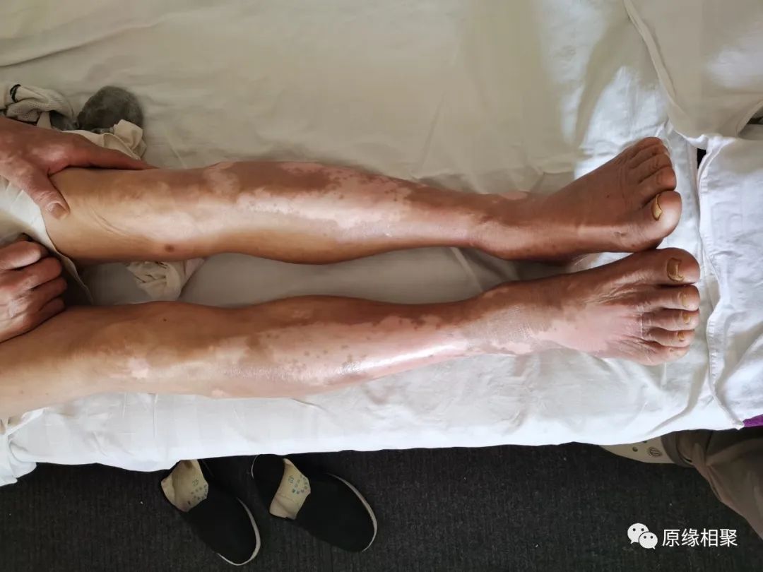 泛发性湿疹 泛发性湿疹