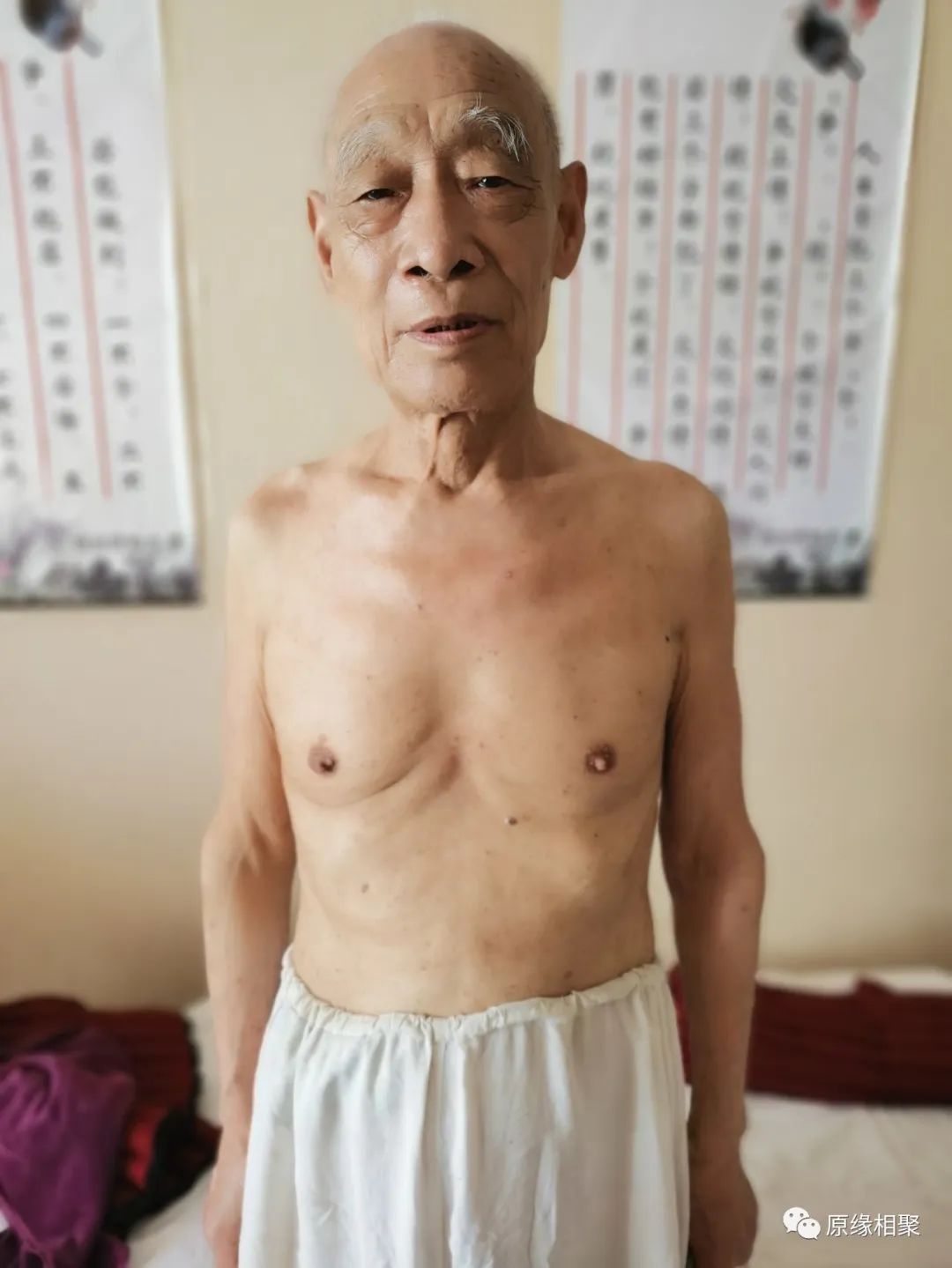 泛发性湿疹 泛发性湿疹