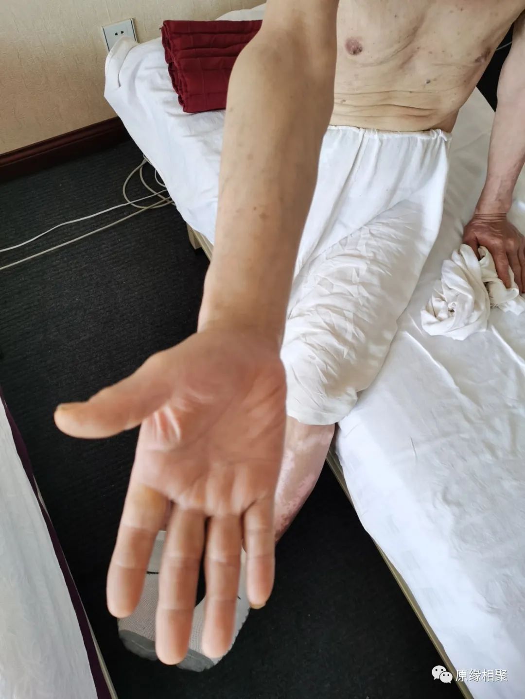 泛发性湿疹 泛发性湿疹