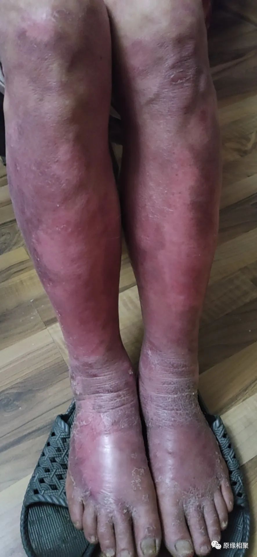 泛发性湿疹 泛发性湿疹