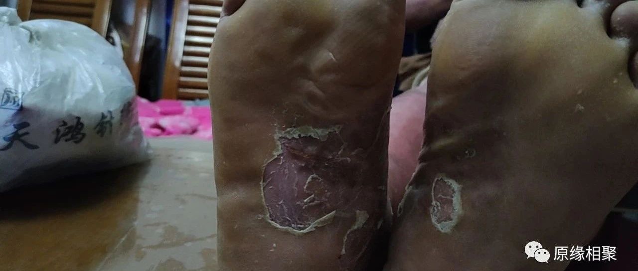 泛发性湿疹-原始点全球同学网
