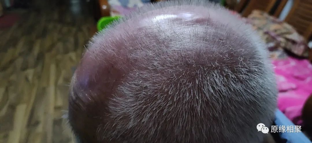 泛发性湿疹 泛发性湿疹