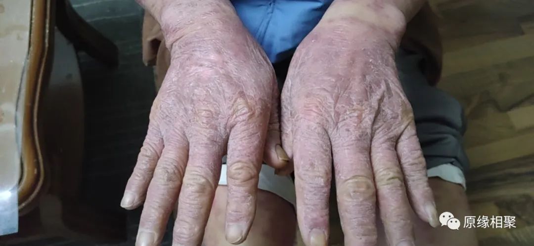 泛发性湿疹 泛发性湿疹