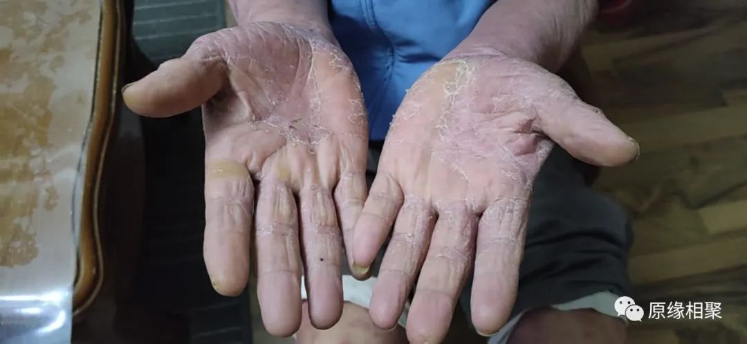 泛发性湿疹 泛发性湿疹