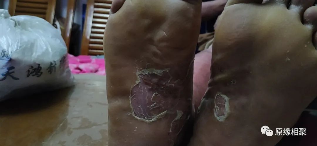 泛发性湿疹 泛发性湿疹