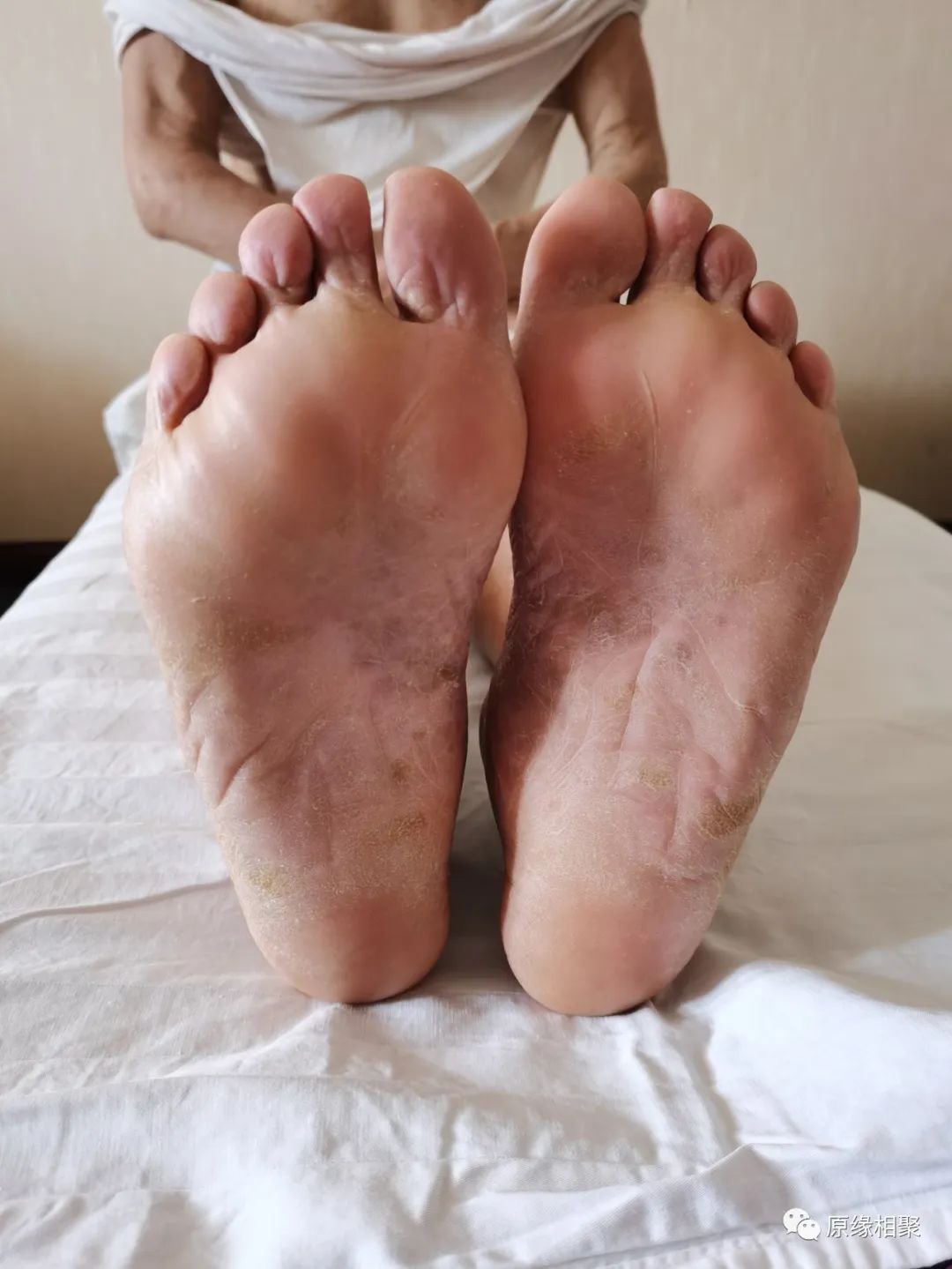 泛发性湿疹 泛发性湿疹