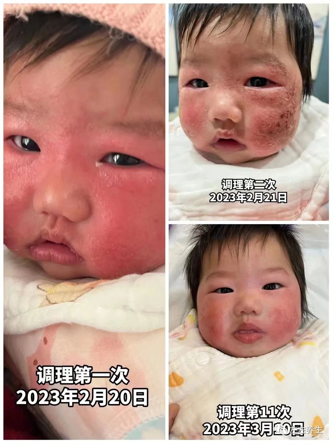 3个月婴儿脸上严重湿疹调理案例 3个月婴儿脸上严重湿疹调理案例