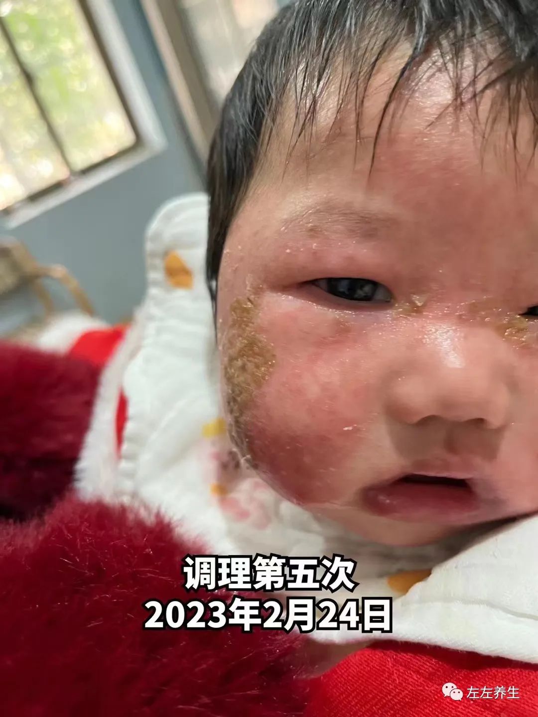 3个月婴儿脸上严重湿疹调理案例 3个月婴儿脸上严重湿疹调理案例